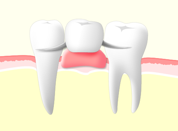 治療法比較 部分入れ歯