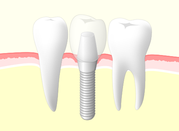 インプラント